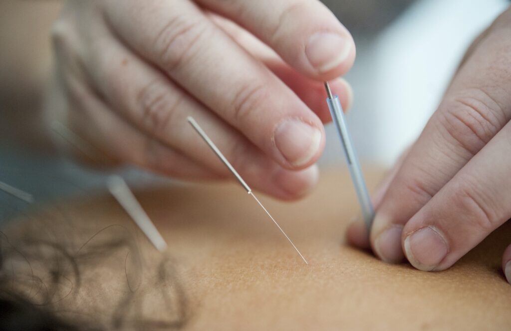 acupunctuur-gevaarlijk